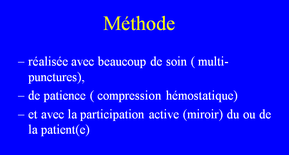 Rhinoplastie medicale a l aide de fillers et d acide hyaluronique 5